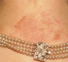 فلزات مورد استفاده در زیورآلات را میشناسید؟ (بخش دوم) 4 حساسیت آلرژی